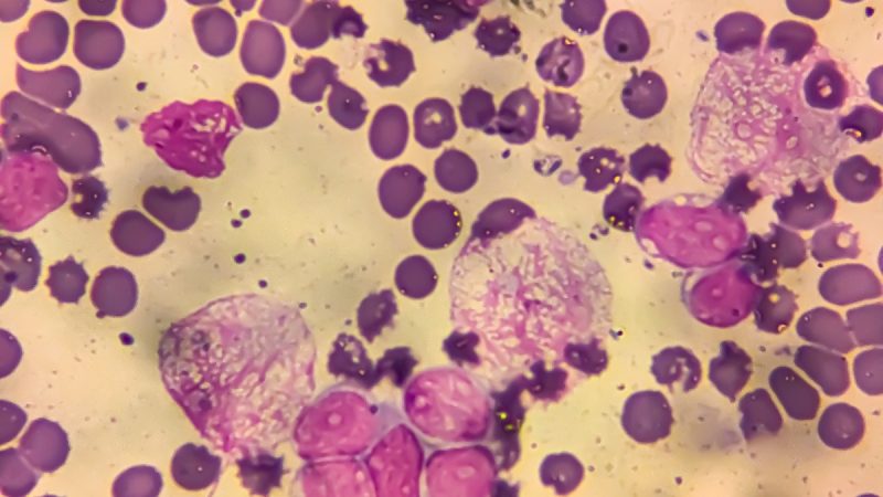 1 in 8 Cancer Cases Worldwide Linked to Infections, Study Finds - Newsweek featured image