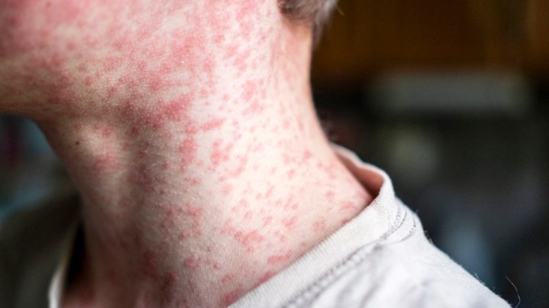 US Measles Cases May Hit 6,500 in 2026 Amid Vaccine Skepticism: Experts - Newsweek