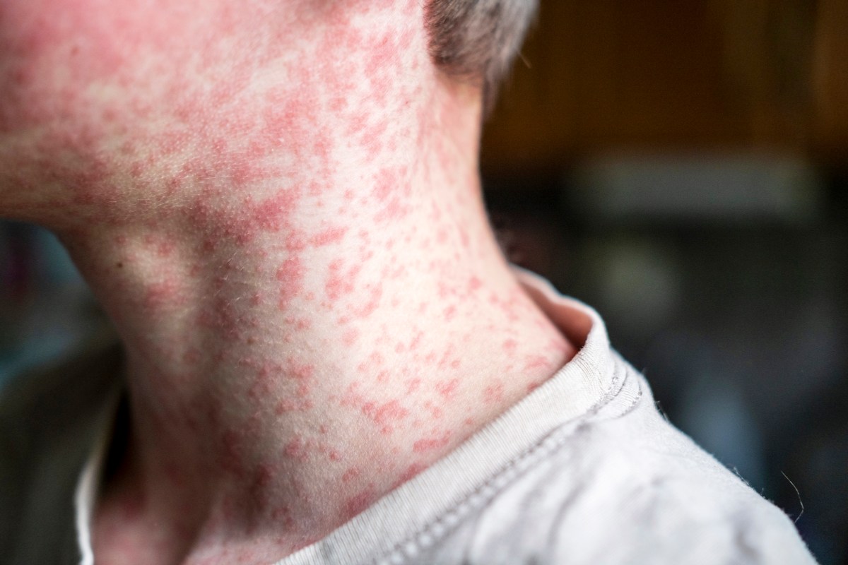 US Measles Cases May Hit 6,500 in 2026 Amid Vaccine Skepticism: Experts - Newsweek