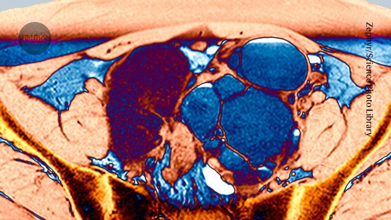 Washington State University Researchers Test Nanotherapy for Endometriosis