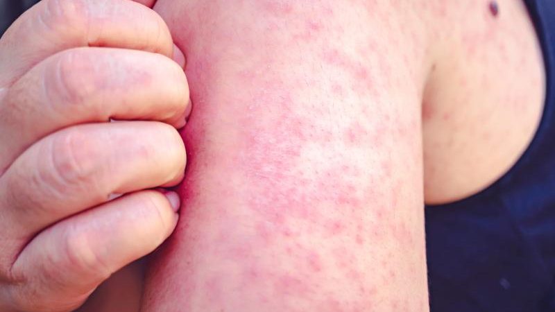 39-Year-Old Unvaccinated Woman Becomes 6th Measles Death in Pennsylvania